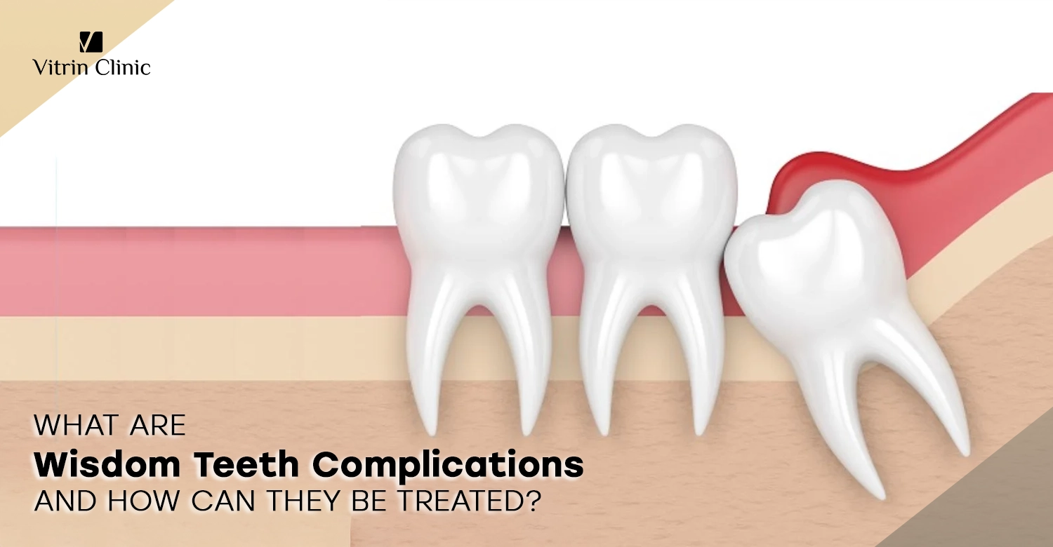 Wisdom teeth complications