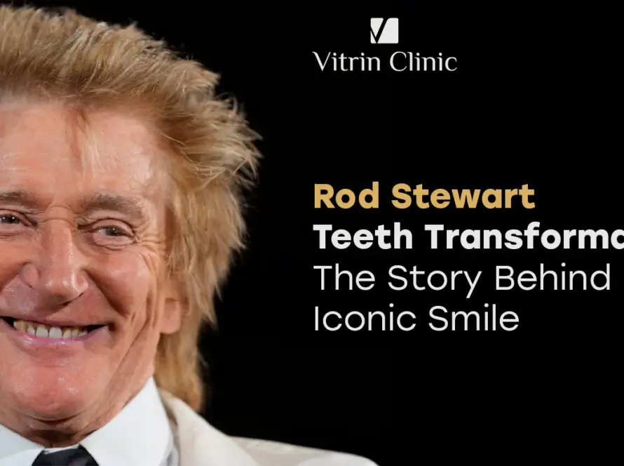   Rod Stewart teeth Transformation