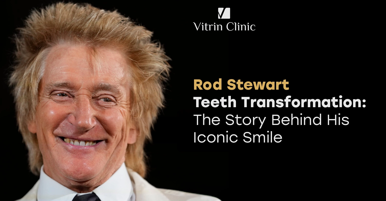  Rod Stewart teeth Transformation