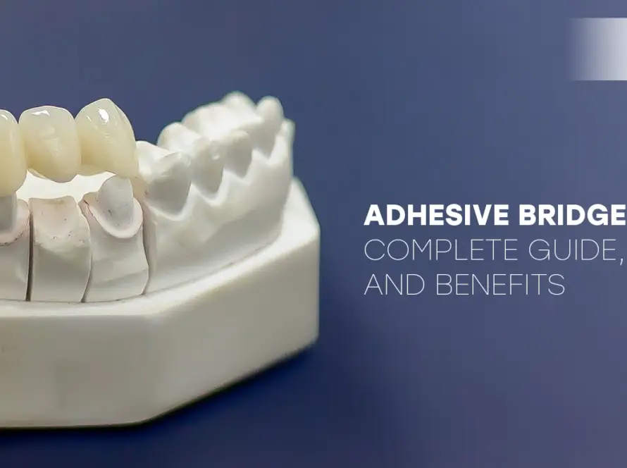 Adhesive Bridge