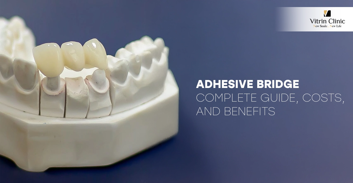 Adhesive Bridge