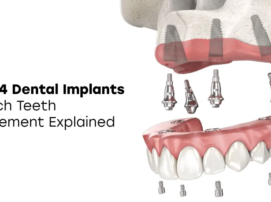 All-on-4 Dental Implants