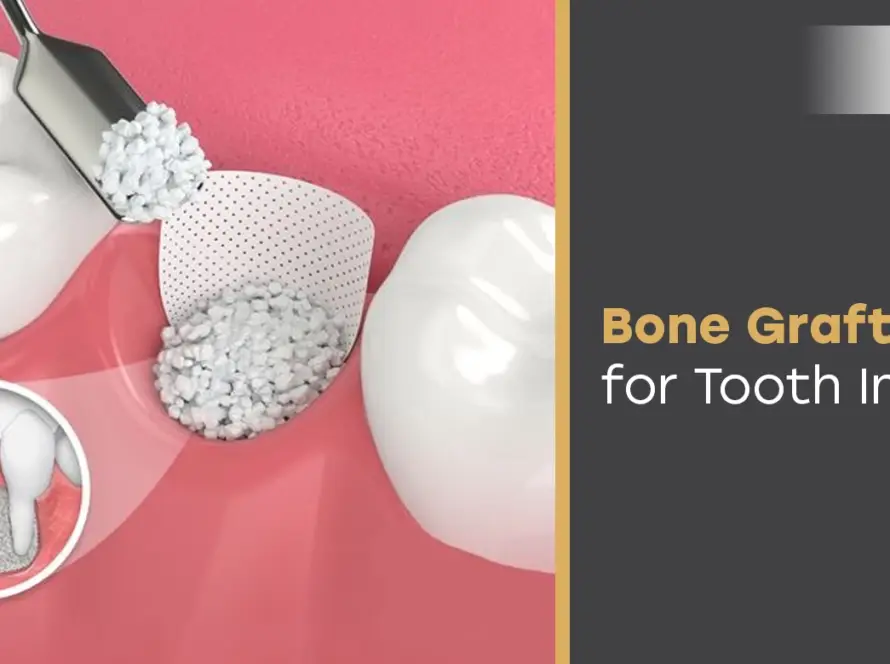 Bone Graft for Tooth Implant