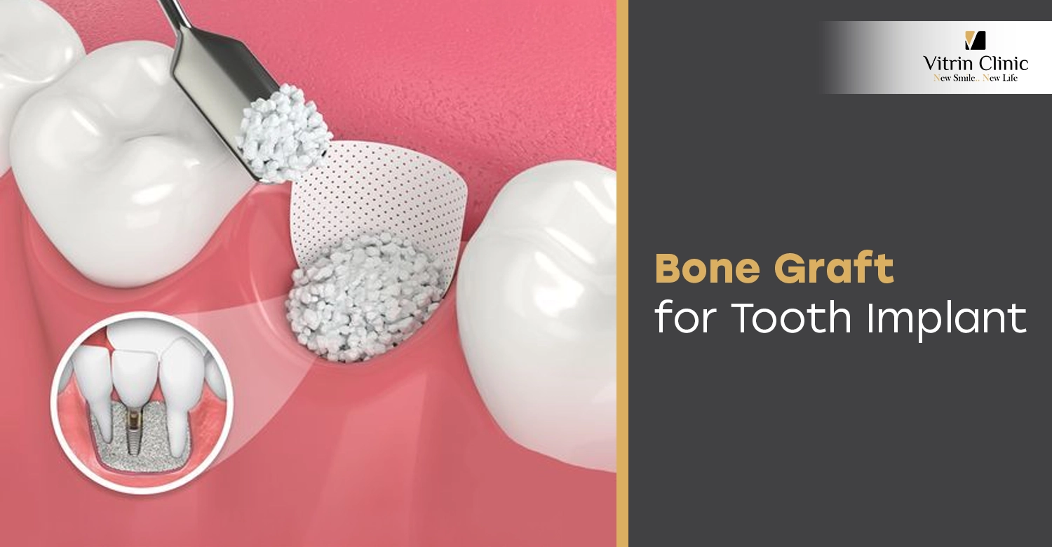 Bone Graft for Tooth Implant