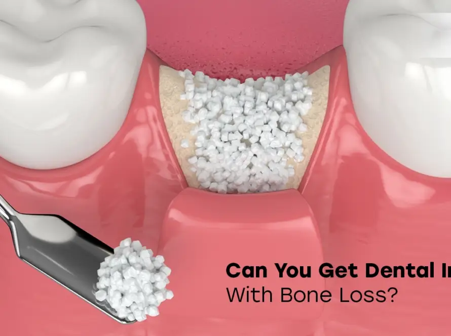 can you get dental implants with bone loss