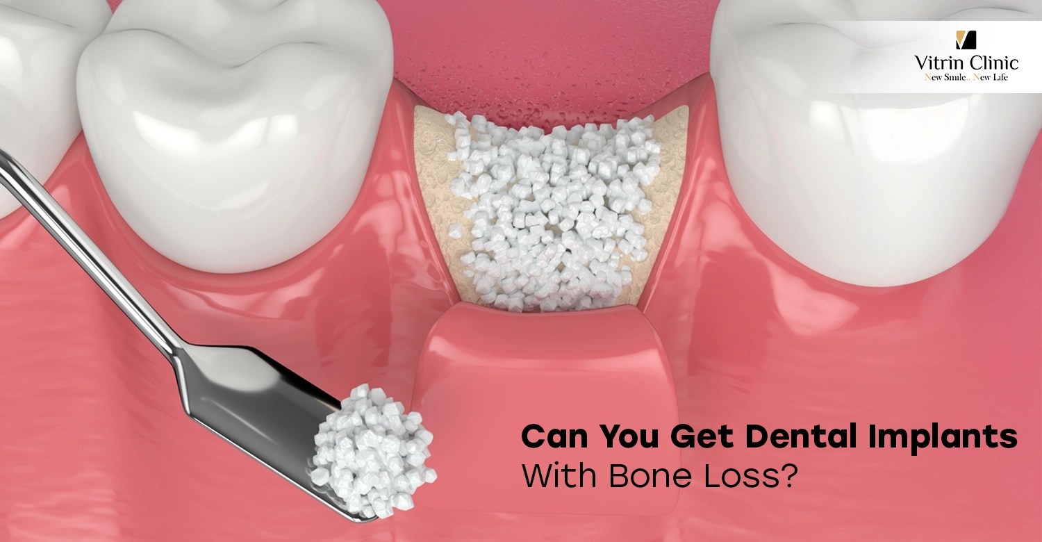 can you get dental implants with bone loss