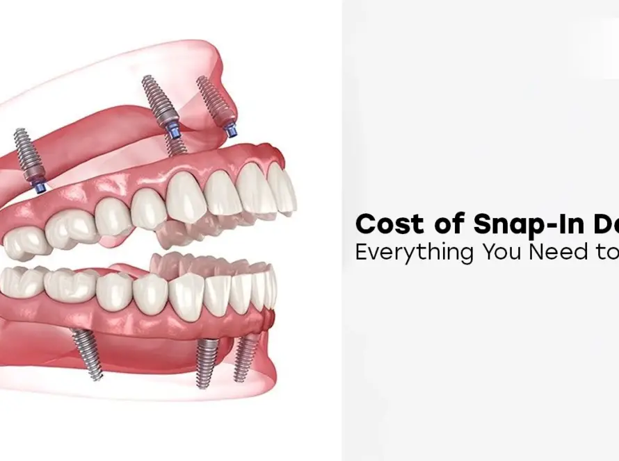 How Much Do Snap-In Dentures Cost