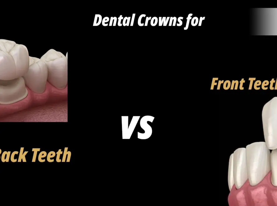 Dental Crowns for Front Teeth vs. Back Teeth.webp