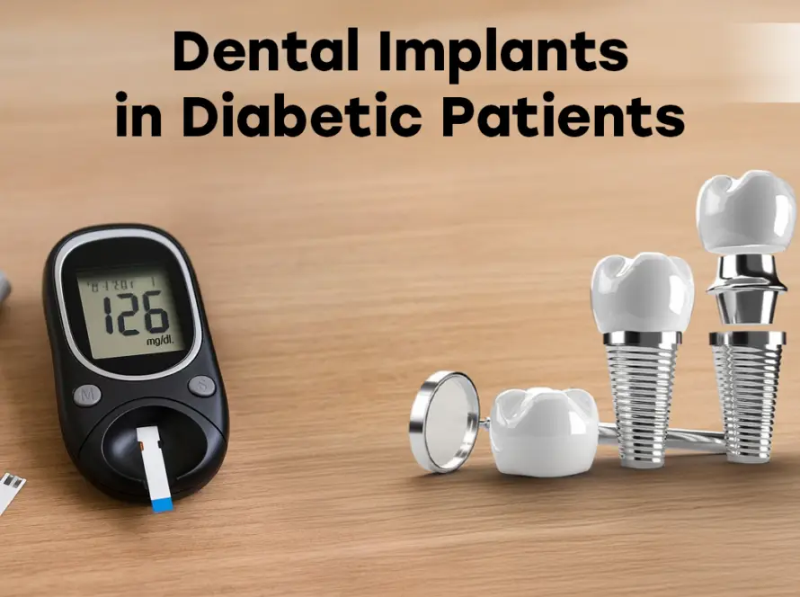 Dental Implants in Diabetic Patients