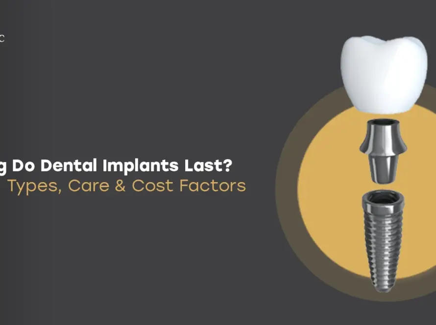 How Long Do Dental Implants Last