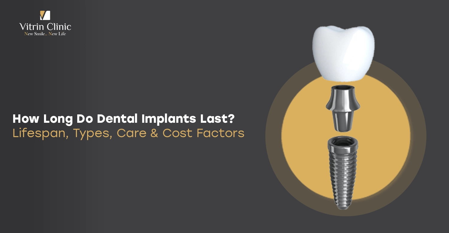 How Long Do Dental Implants Last