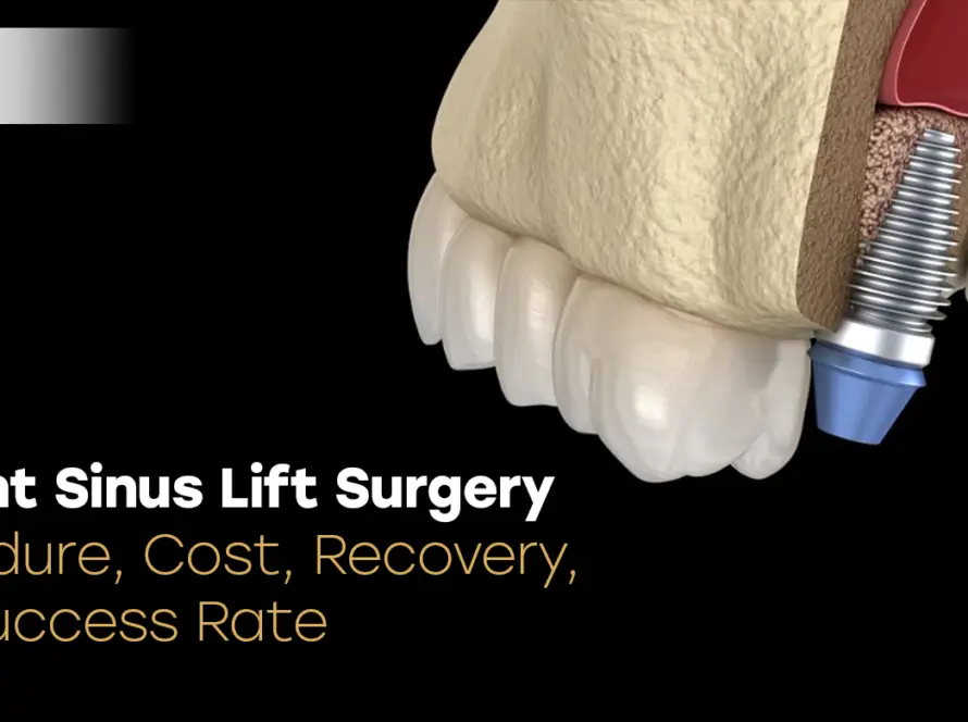 Implant Sinus Lift Surgery