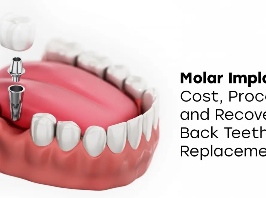 Molar Implants
