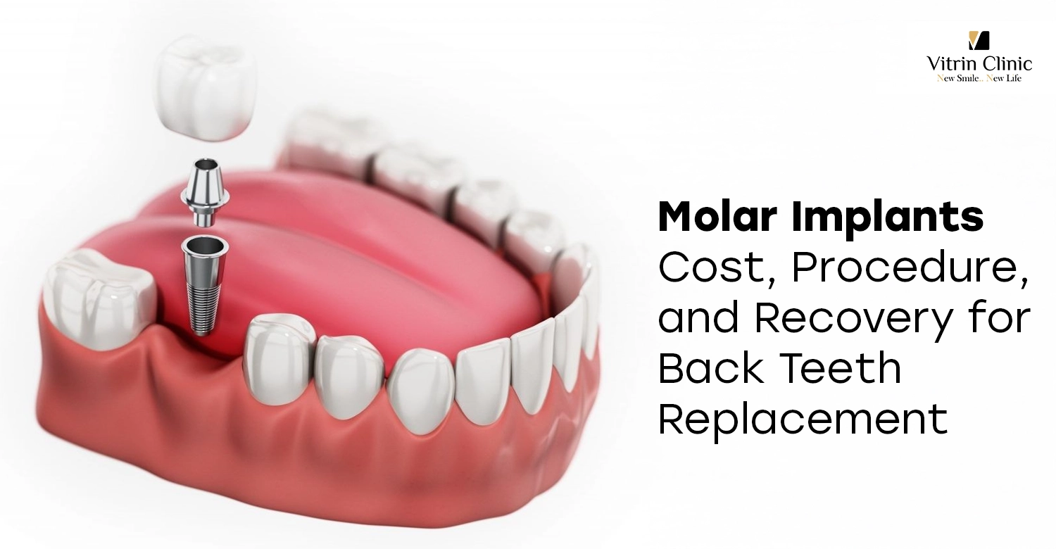 Molar Implants