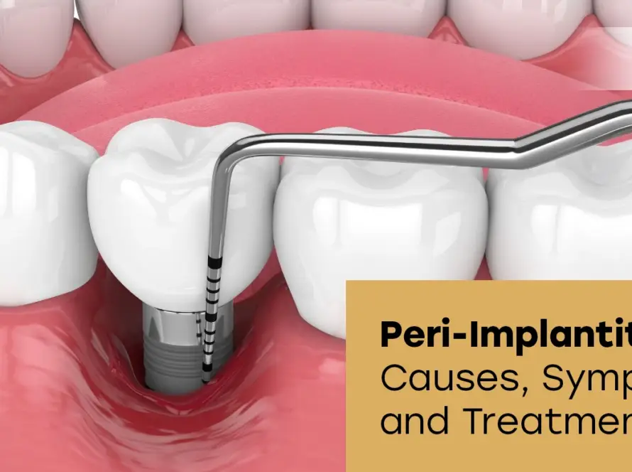 Peri-Implantitis: Causes, Symptoms, and Treatment for Dental Implant Infection