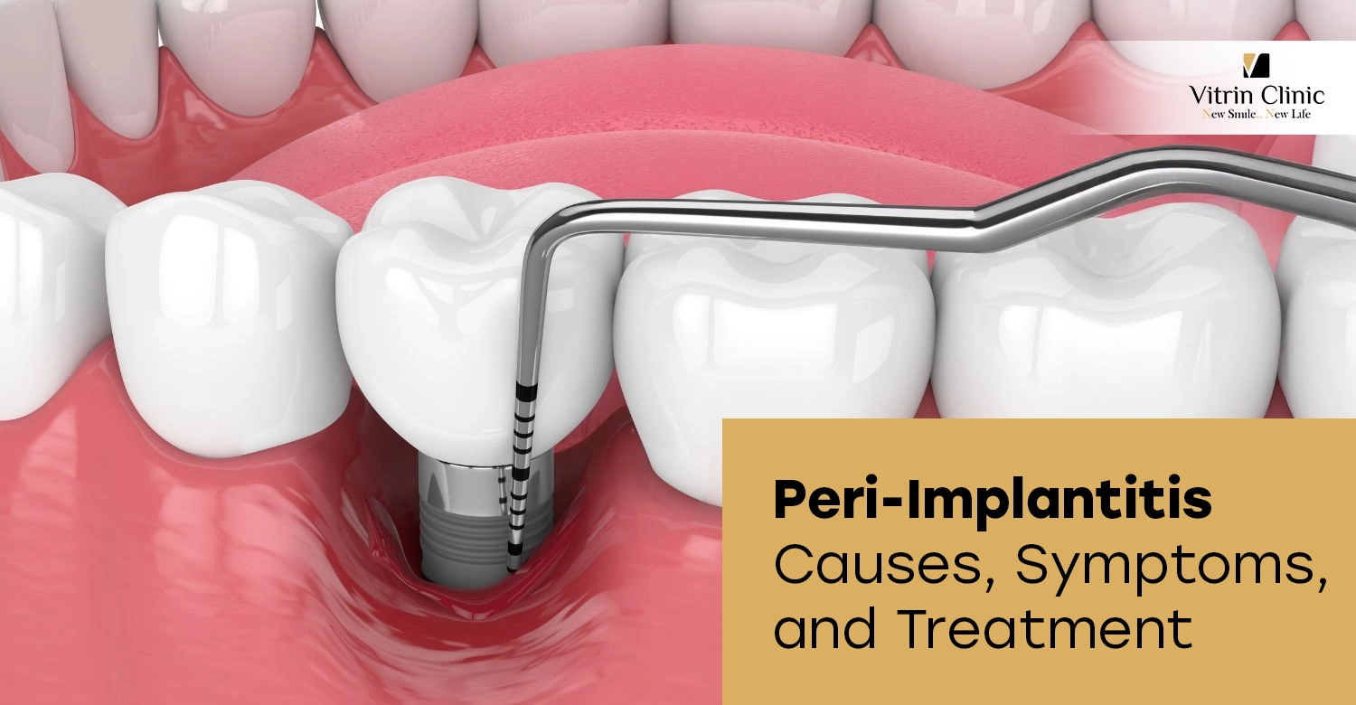 Peri-Implantitis: Causes, Symptoms, and Treatment for Dental Implant Infection