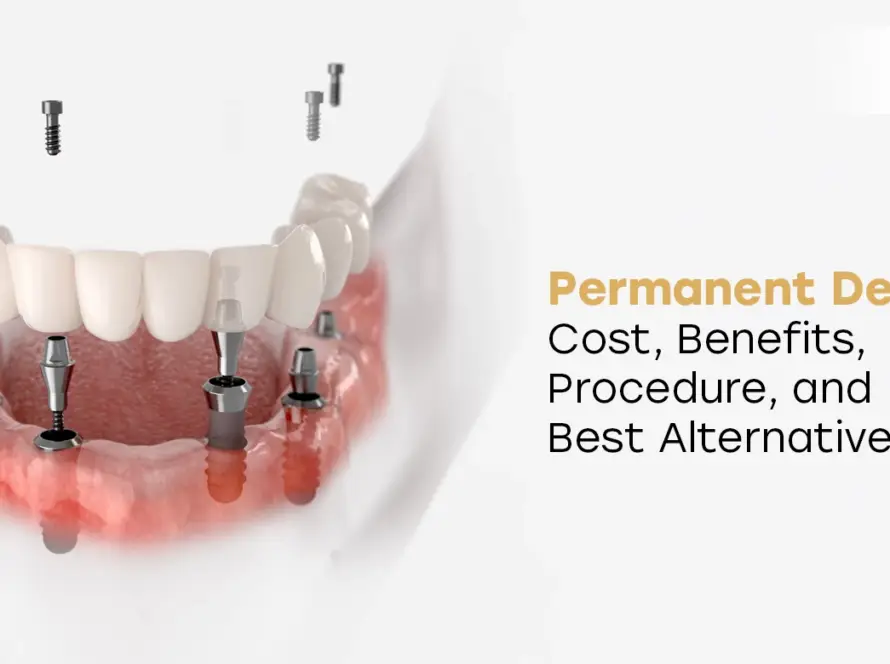 Permanent Dentures