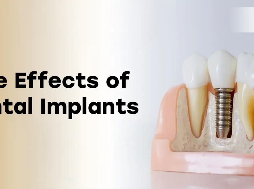 Side Effects of Dental Implants