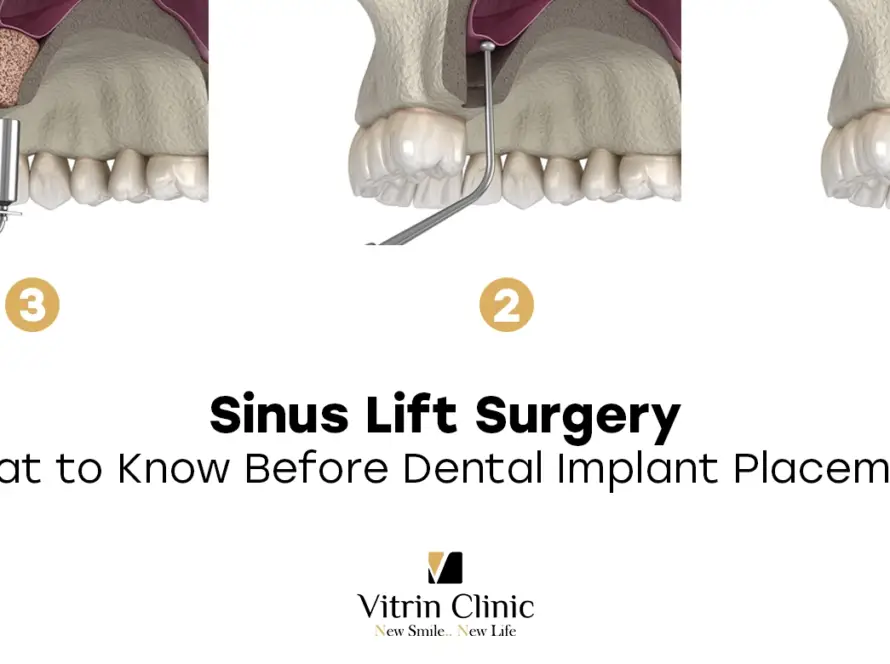 Sinus Lift Surgery