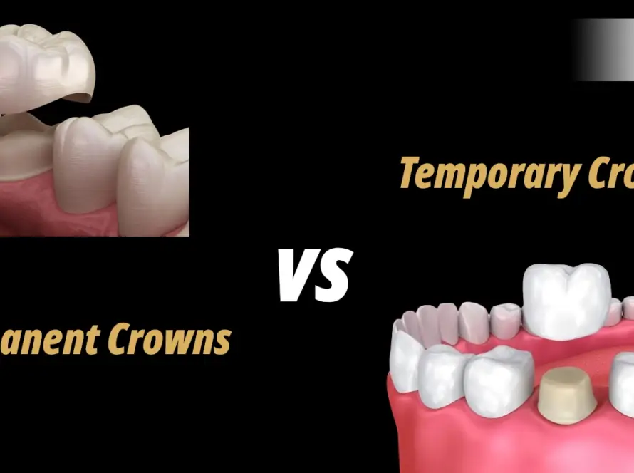 Temporary Crowns vs Permanent Crowns