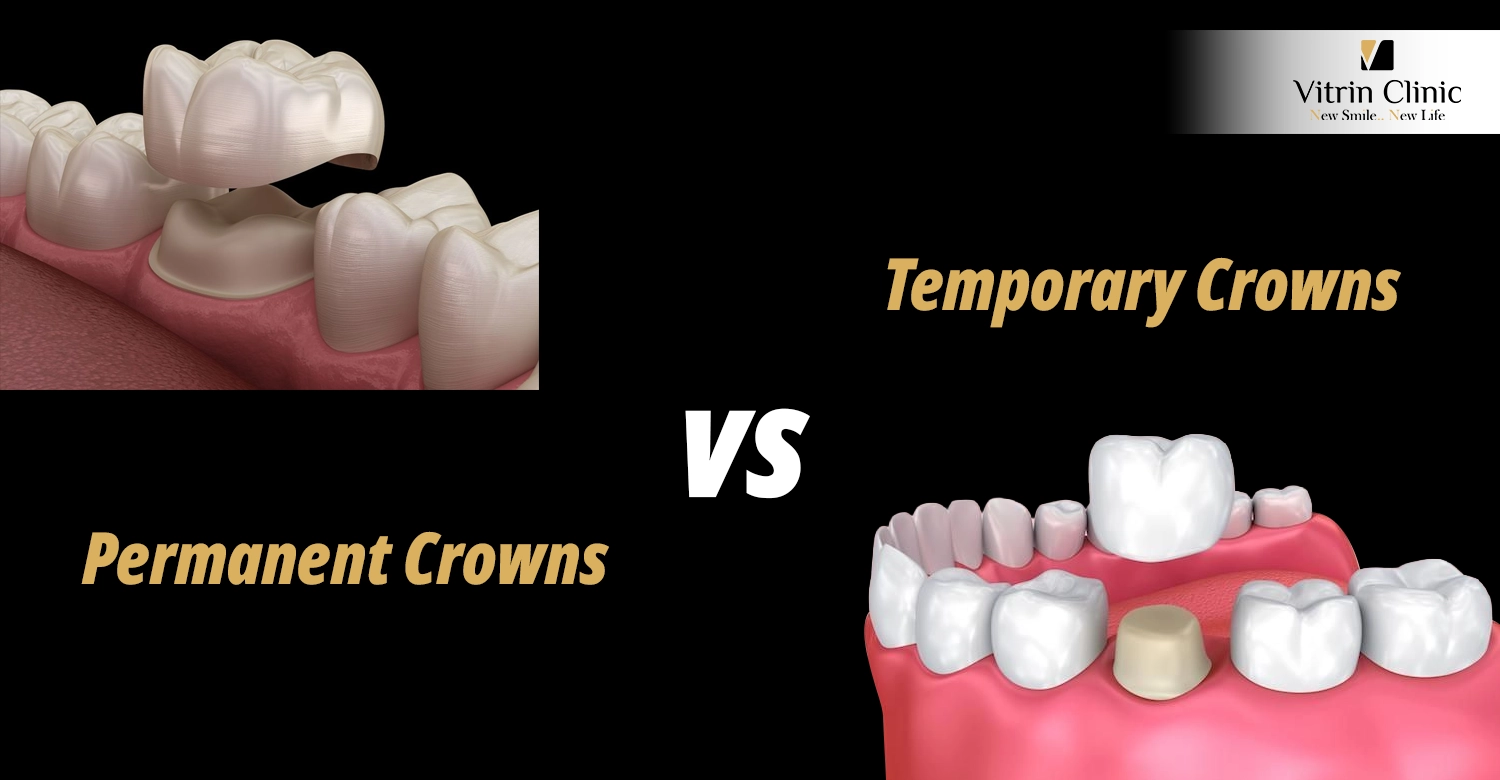 Temporary Crowns vs Permanent Crowns