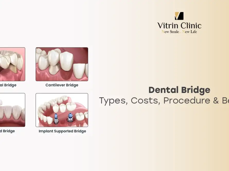 Dental Bridge