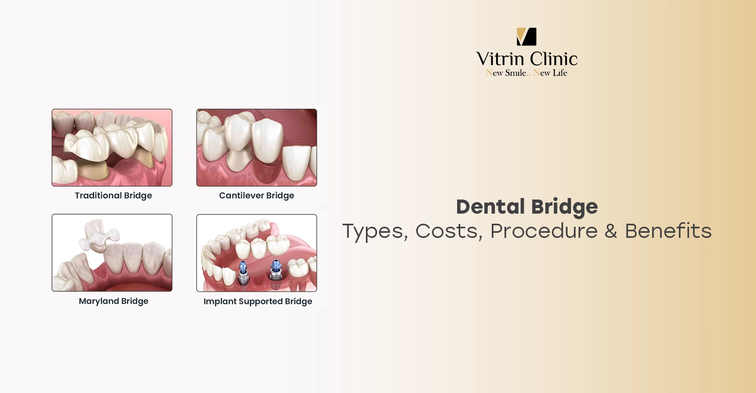 Dental Bridge