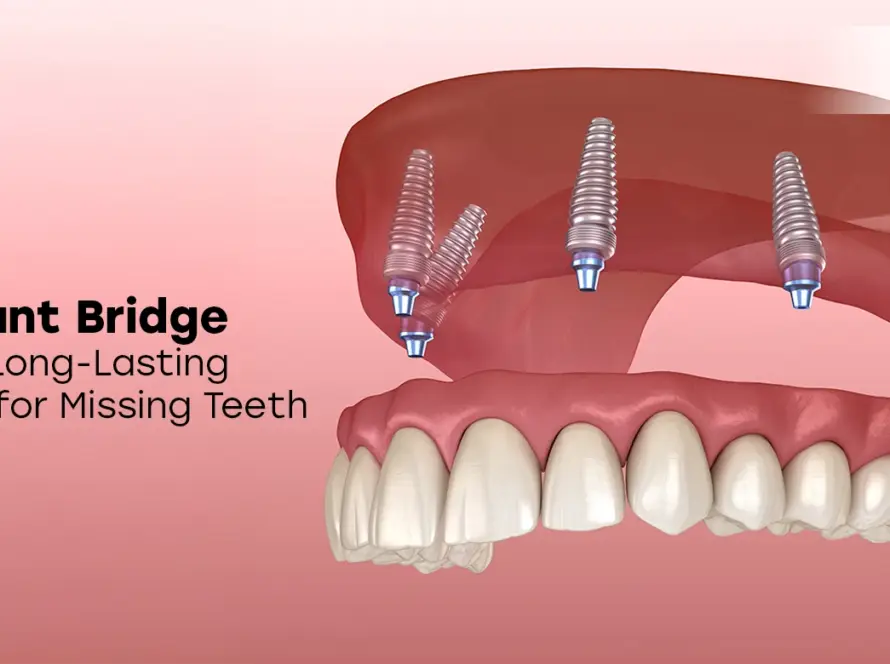 4 Implant Bridge