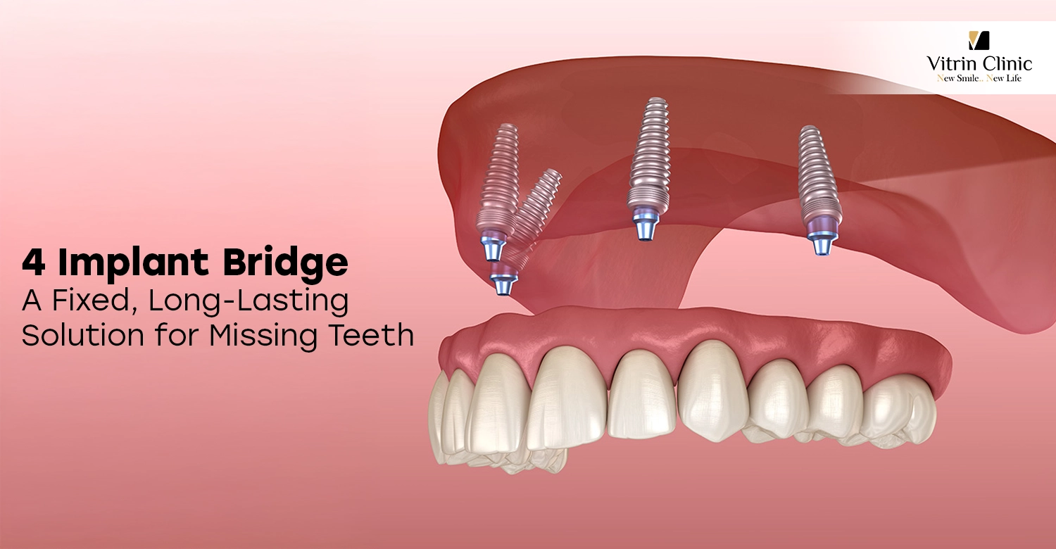 4 Implant Bridge