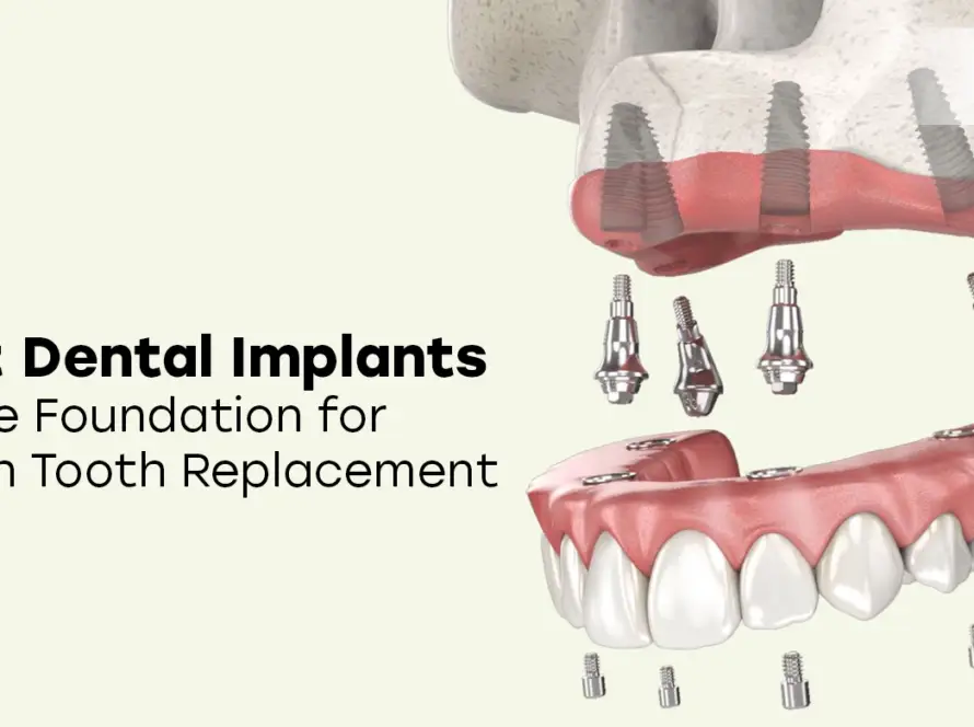 4 Post Dental Implants