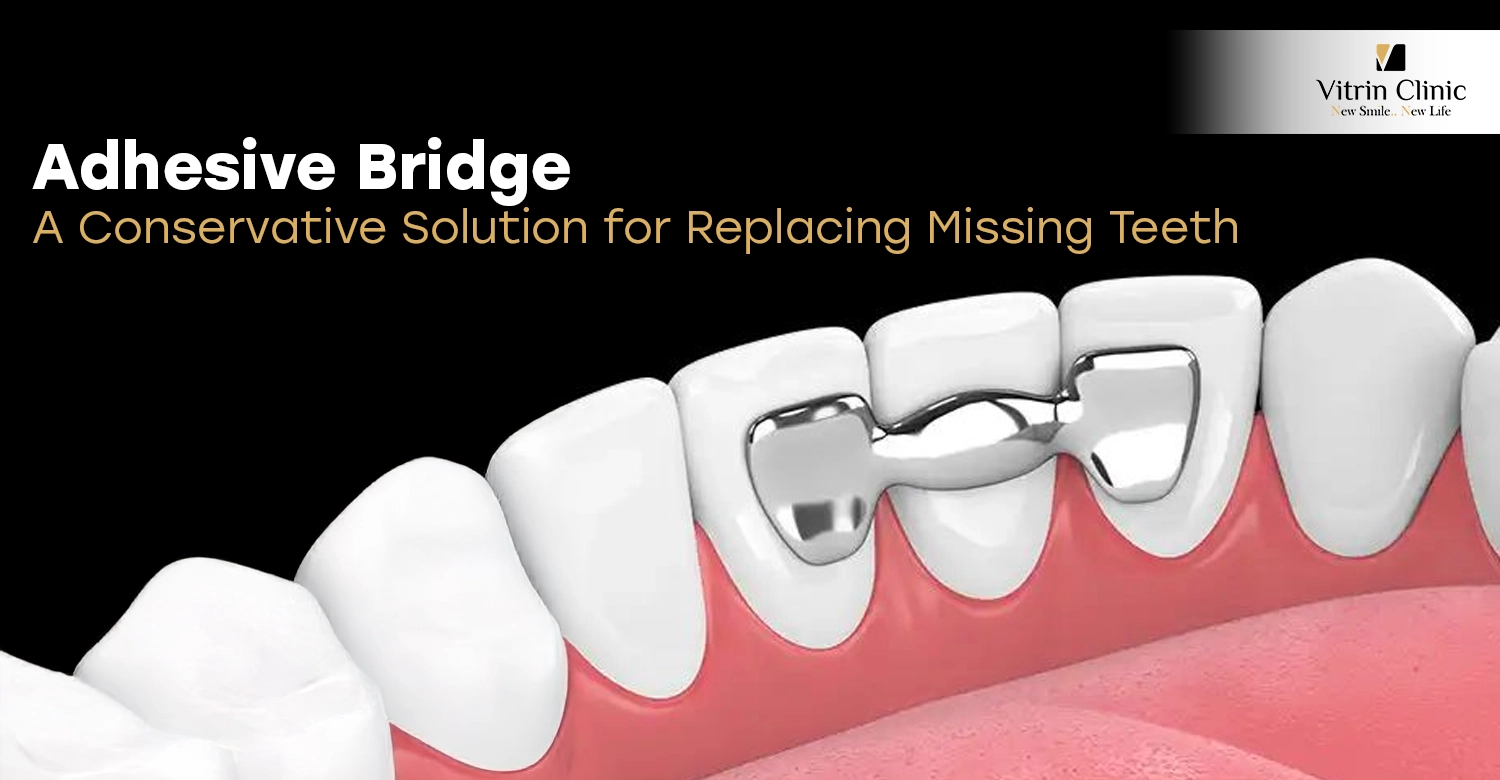 Adhesive Bridge