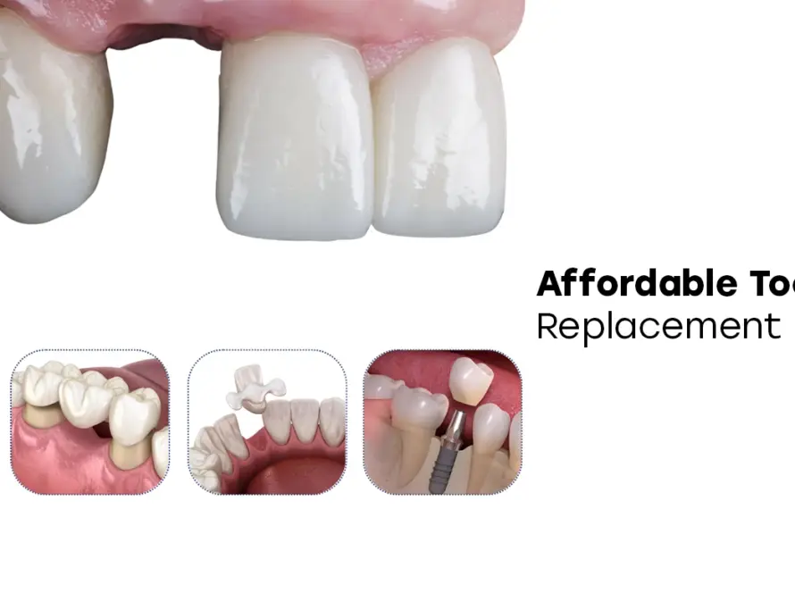 Affordable Tooth Replacement Options