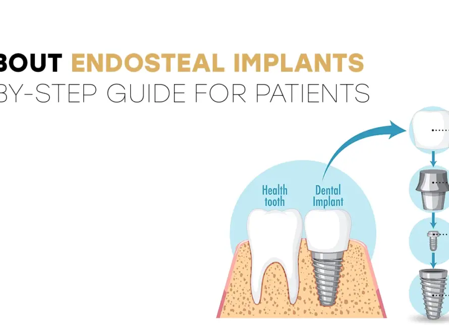 All About Endosteal Implants