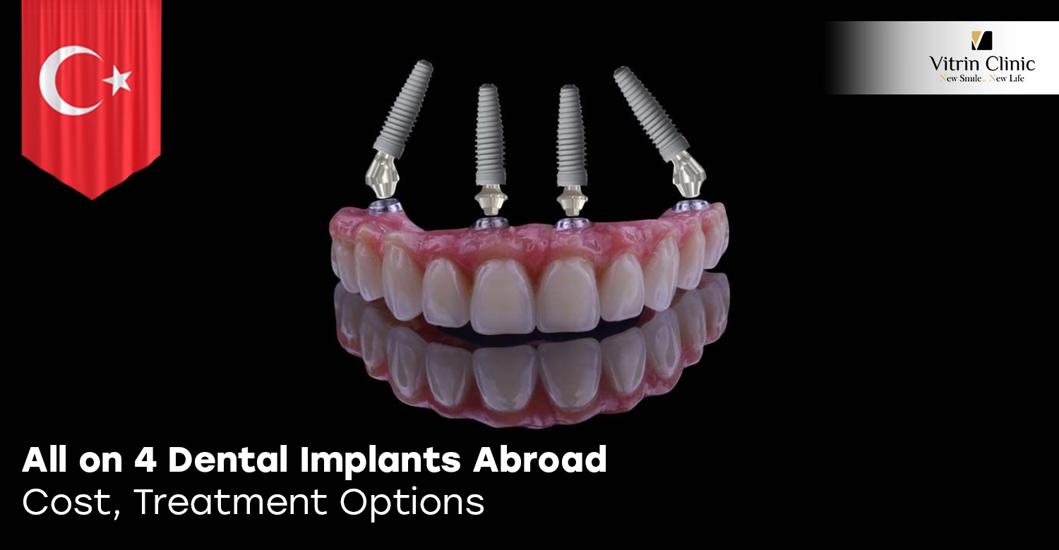 all on 4 dental implants abroad