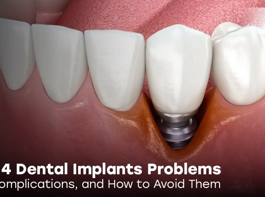 all on 4 dental implants problems