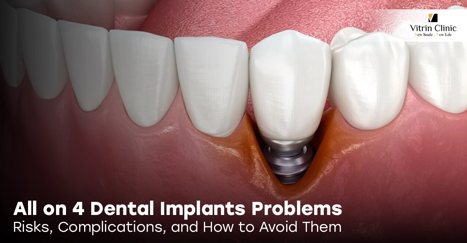 all on 4 dental implants problems