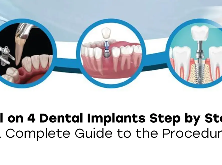 all on 4 dental implants step by step