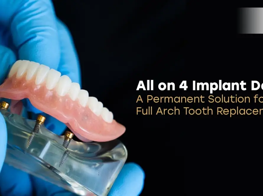 All on 4 Implant Dentures