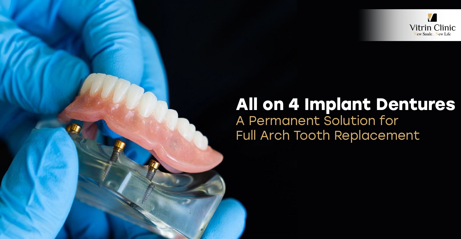 All on 4 Implant Dentures