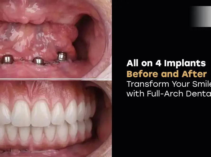 all on 4 implants before and after