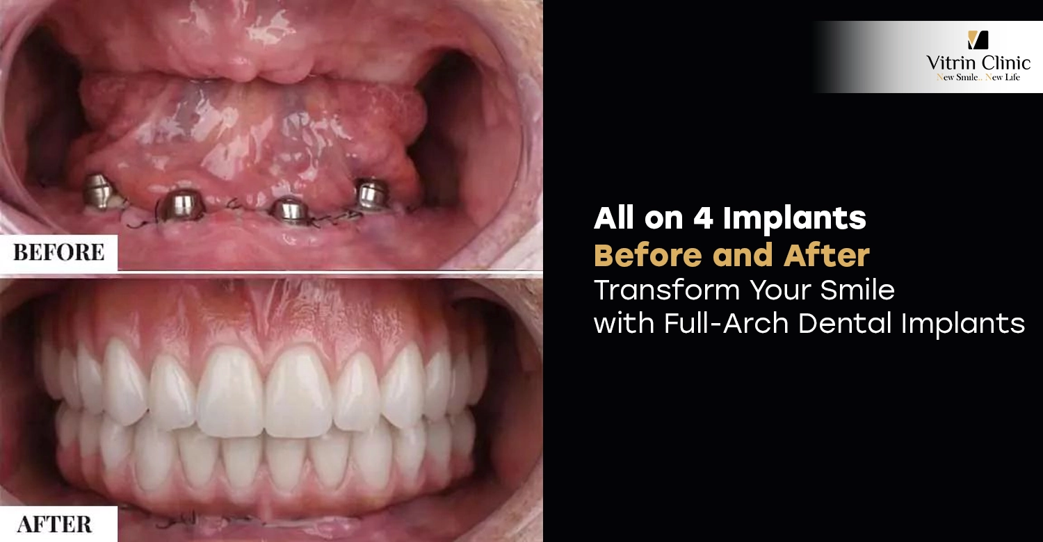 all on 4 implants before and after
