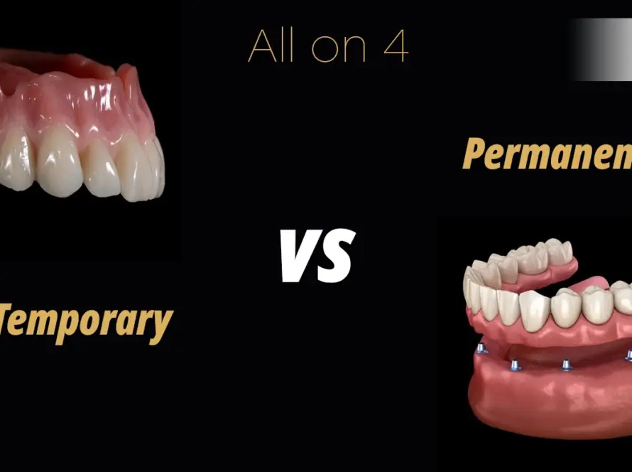 All on 4 Temporary vs Permanent