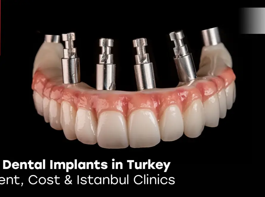 All on 6 Dental Implants in Turkey