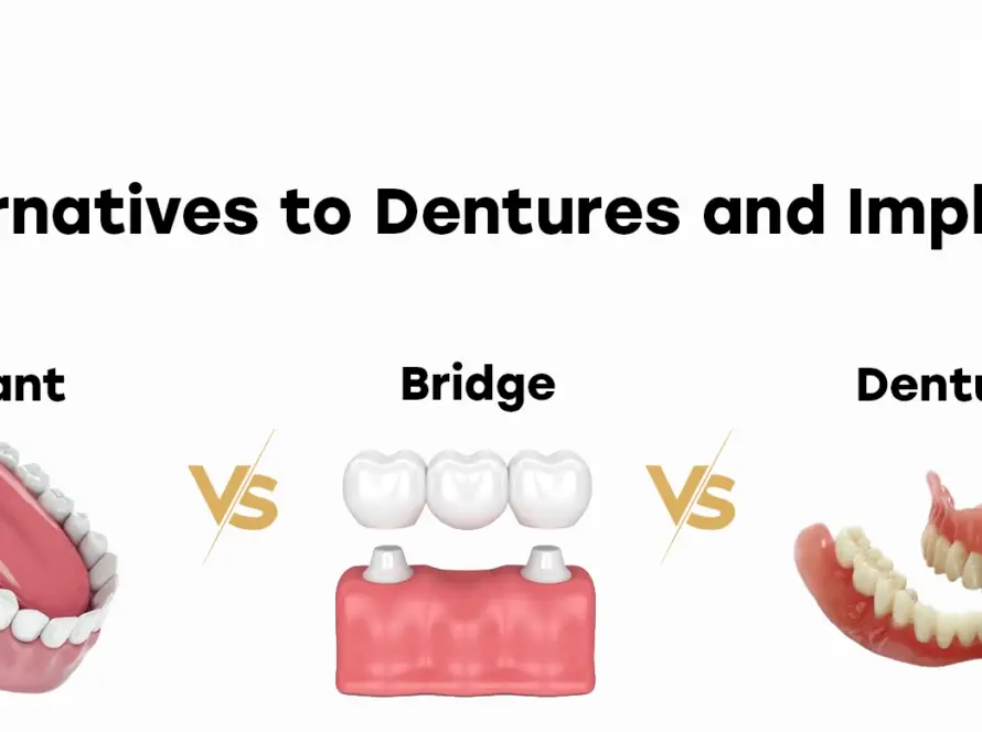 Alternatives to Dentures and Implants