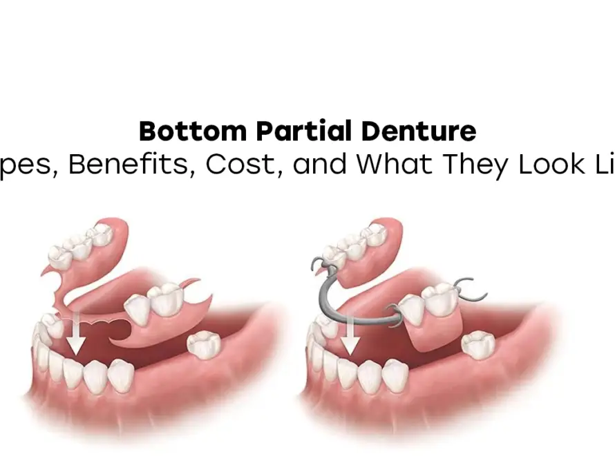 Bottom Partial Denture