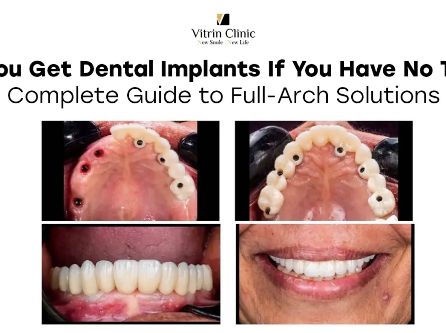 Can you get dental implants if you have no teeth