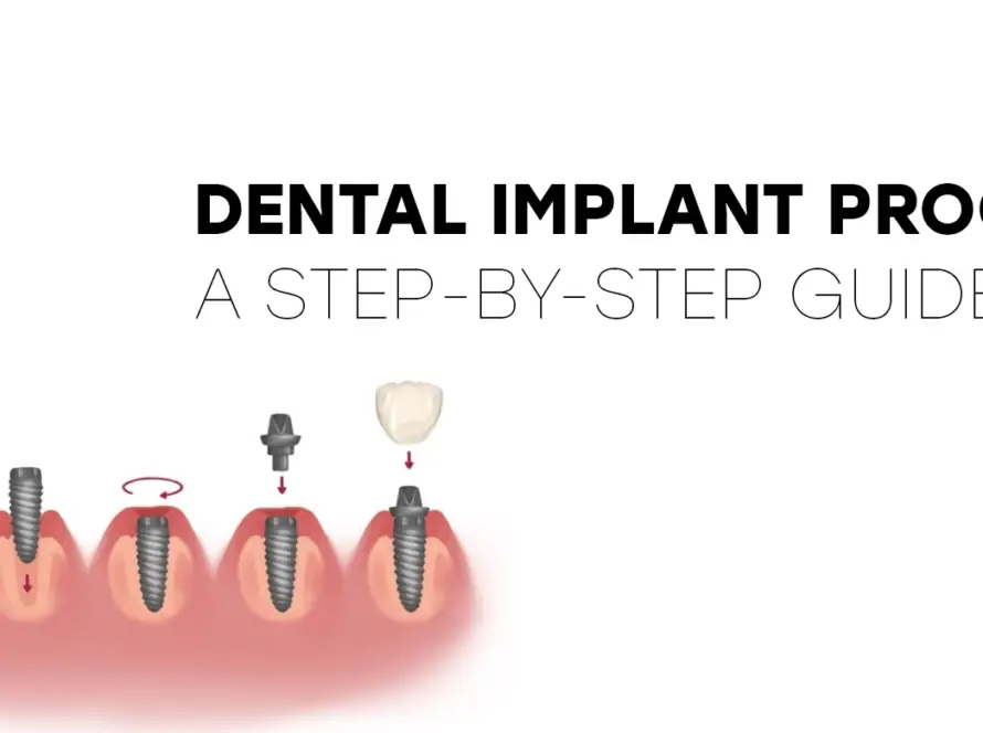 Dental Implant Process