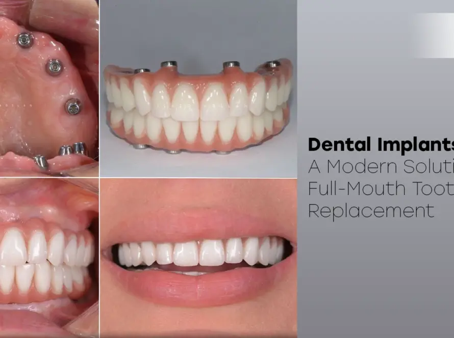 Dental implants all on 6