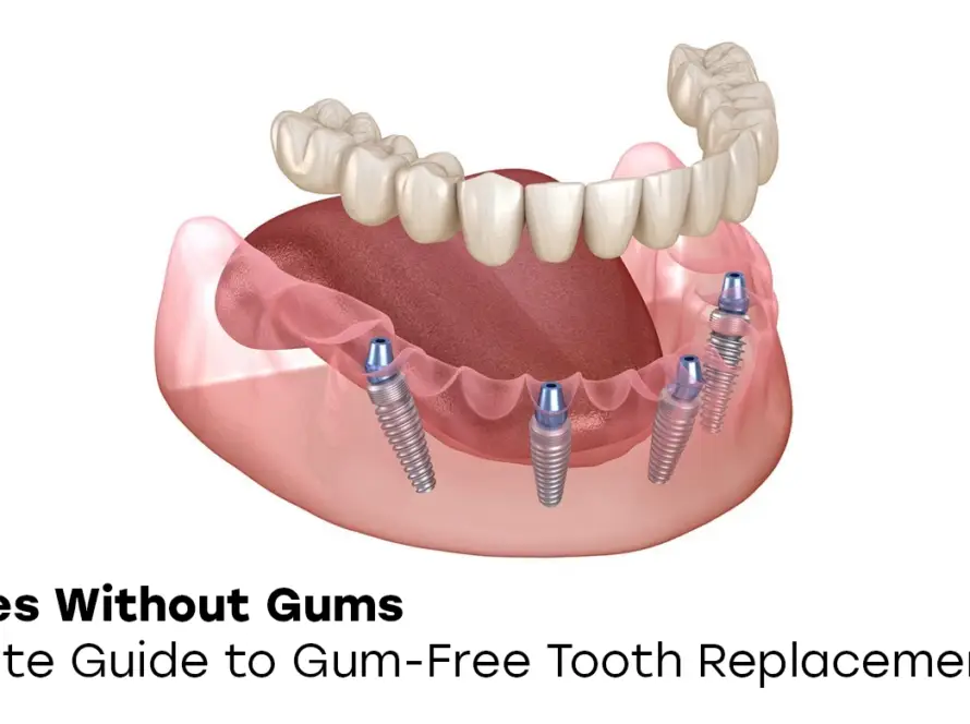 Dentures without gums