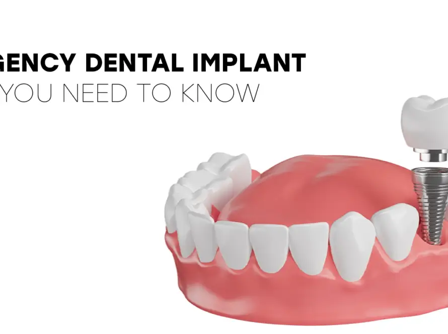 emergency dental implant